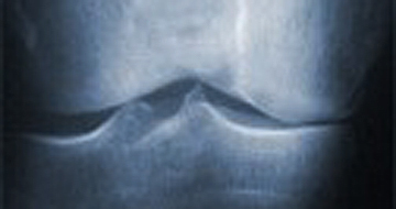 Arthrose