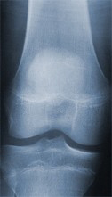 Arthrose