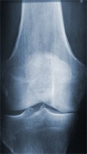 Arthrose